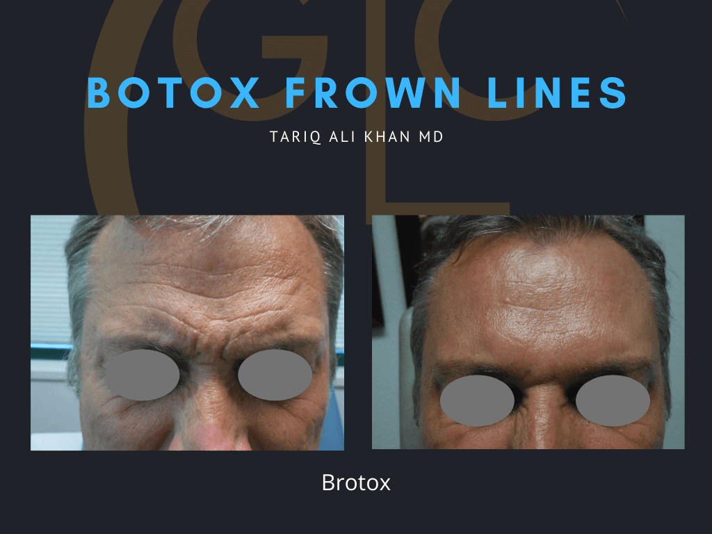 Gentle Care Laser Tustin & Long Beach Before and After picture - Botox