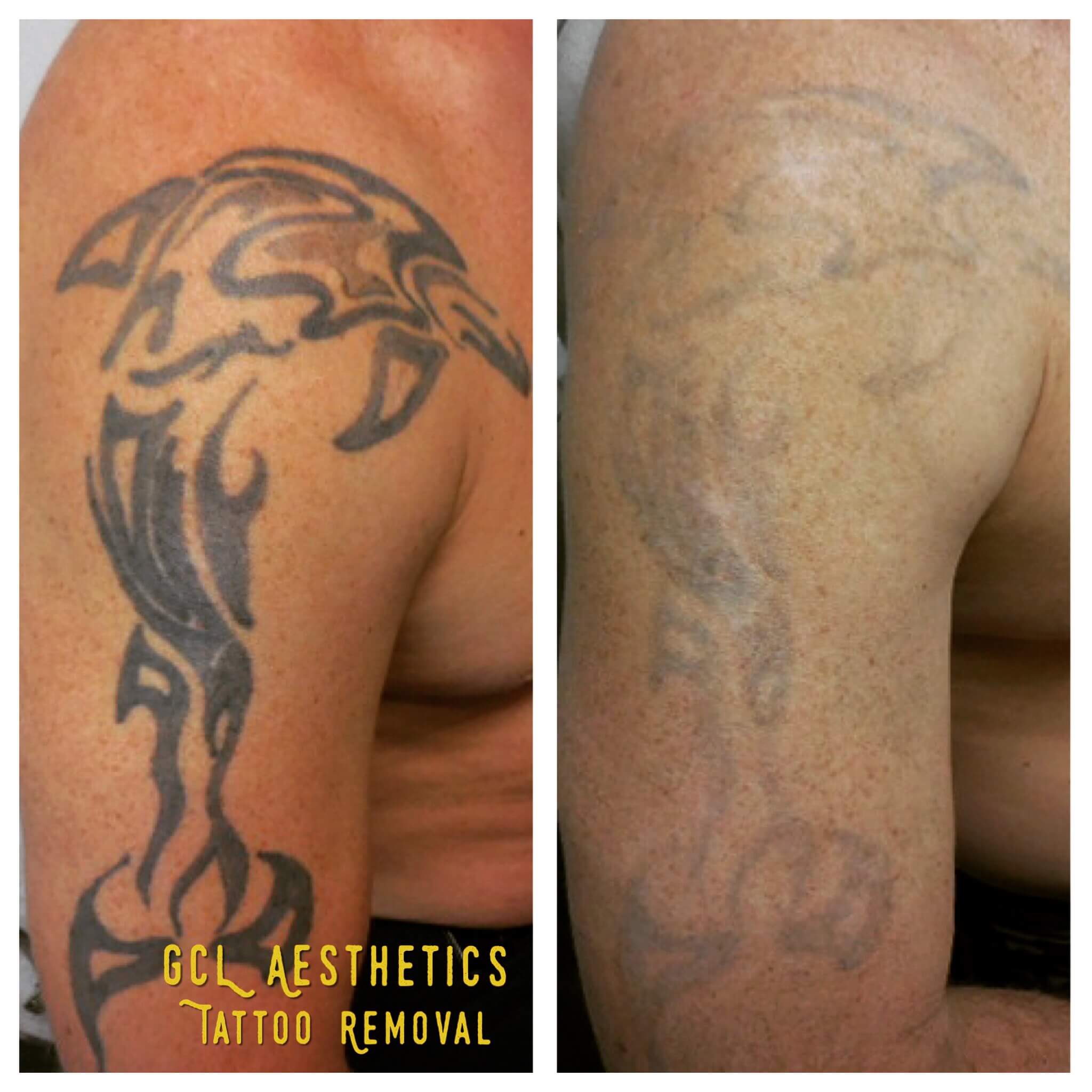 laser tattoo removal orange county